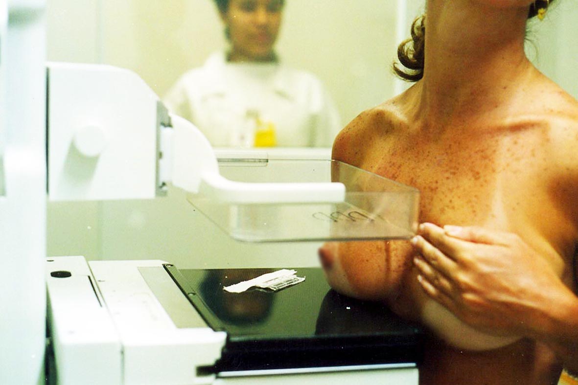 Mamografia deve ser feita anualmente por mulheres acima de 40 anos. albertomarques.blogspot.com