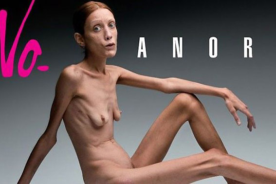 Isabelle Caro em foto de campanha contra anorexia.Oliviero Toscani/Divulgação